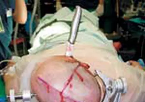 A avut un cutit infipt in cap