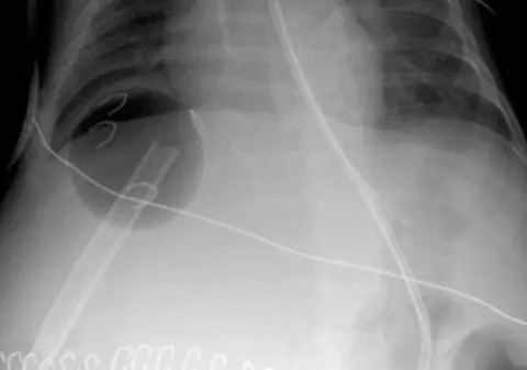 I-au implantat o minge de ping-pong sub ficat