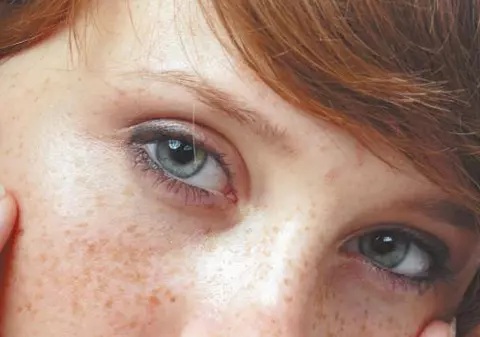 Scapă de pistrui doar într-o lună