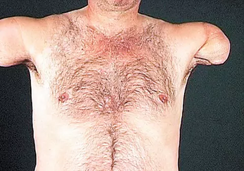 "Mă simt din nou întreg"