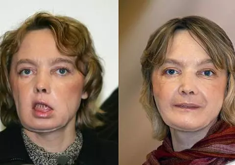 Femeia cu transplant de faţă nu se simte în pielea ei