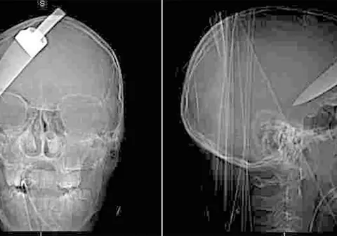 Înjunghiat în cap! 