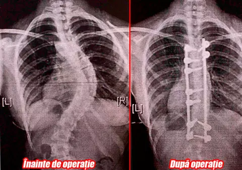 A crescut cu 5 centimetri după ce i-au îndreptat coloana