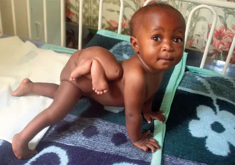 S-a născut o fetiţă cu patru picioare!!!