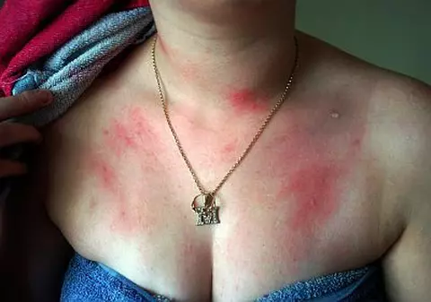 Nu se poate spăla nici pe ea şi nici copilul pentru că e alergică la apă