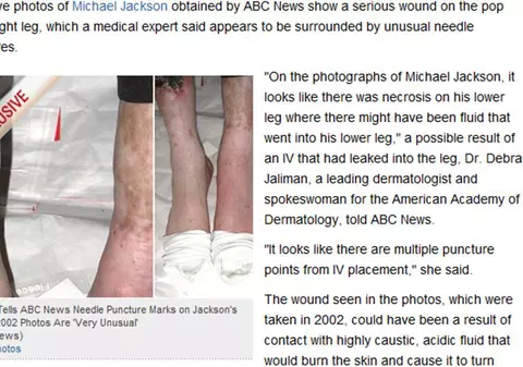 Imagini şocante cu picioarele lui Michael Jackson