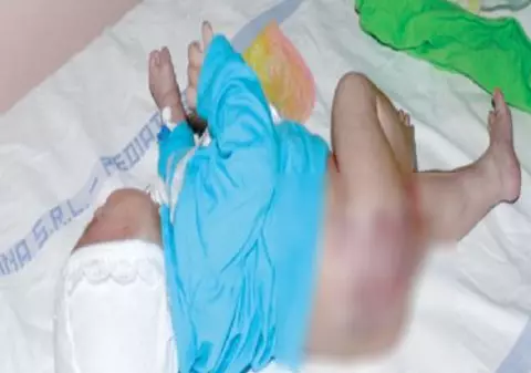 Un nou-născut riscă să-şi piardă un picior