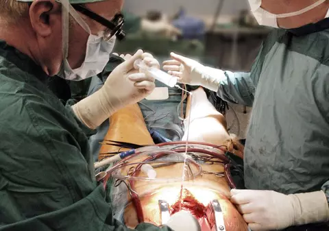 Au implantat cea mai mică pompă cardiacă din lume
