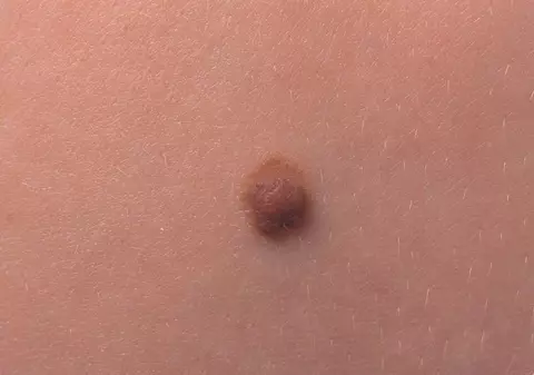 Cancerul de piele poate fi învins