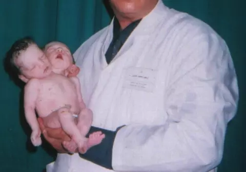 Fetiţa cu două capete a murit