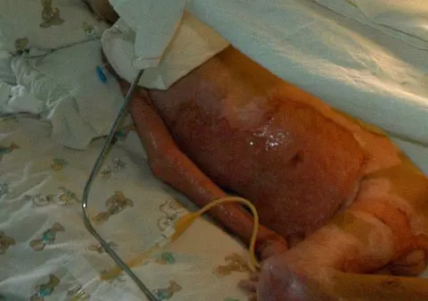 Un copil a ajuns la spital după ce a căzut în oala cu ciorbă 