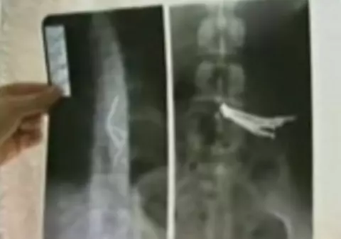 Supărat că a fost părăsit de iubită, a înghiţit un pumn de cuie