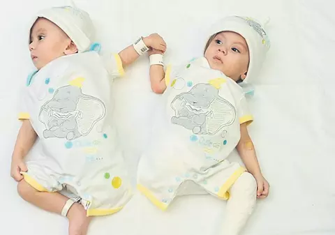 Siamezii separaţi se ţin şi acum de mână ca în burtica mamei