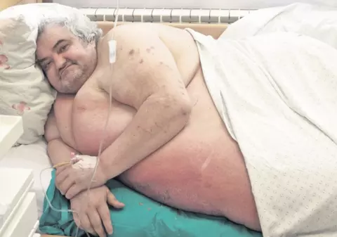 Dacă ar fi mers la medic mai devreme, românul de 350 kg ar fi avut şanse la viaţă
