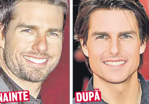 Tom Cruise face injecţii cu botox?
