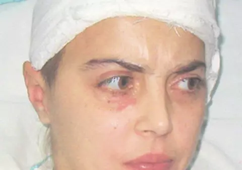 Femeia strivită de tencuiala de pe un imobil şi-a revenit din moarte clinică, dar nu are bani de tratament