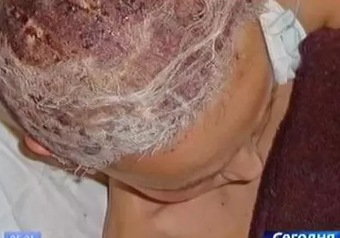 O fetiţă de zece ani a luat foc pe masa de operaţii
