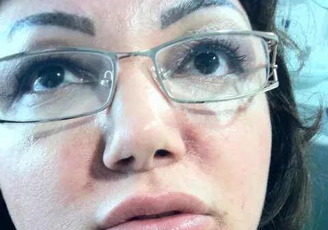 Ozana Barabancea, cu faţa distrusă de un tratament de hidratare a pielii: ”Mi-e groază să mă uit in oglindă”