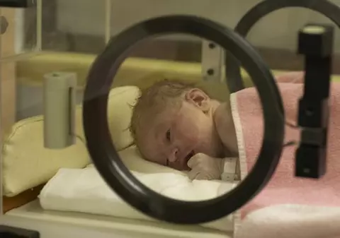 O indiancă a născut un bebeluș fără nas și cu un ochi în jumătatea frunții