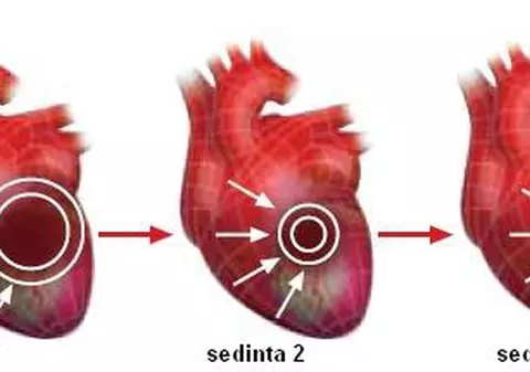 Revascularizarea inimii cu ajutorul undelor acustice - CardioFort