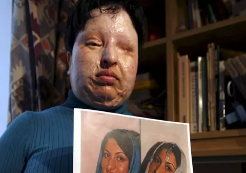 Iranianul condamnat la orbire cu acid a fost iertat de victima sa