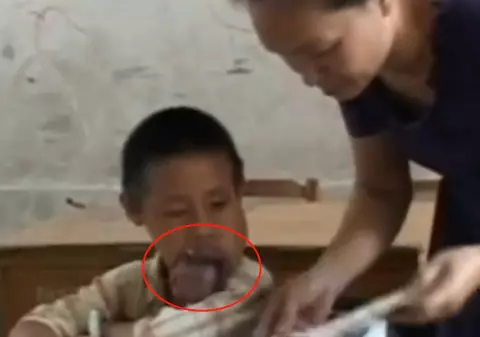 Un chinez de opt ani suferă de o boală cruntă: îi crește limba