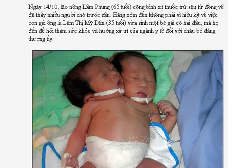 Şocant! O vietnameză a născut o fetiţă cu două capete şi trei mâini