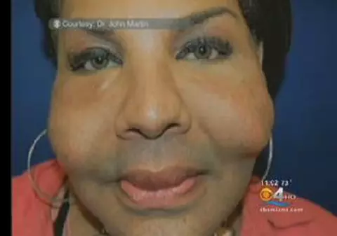 ÎNGROZITOR! Obraji plini cu ciment, în loc de silicon! Uite încă o victimă a medicului ”beton”