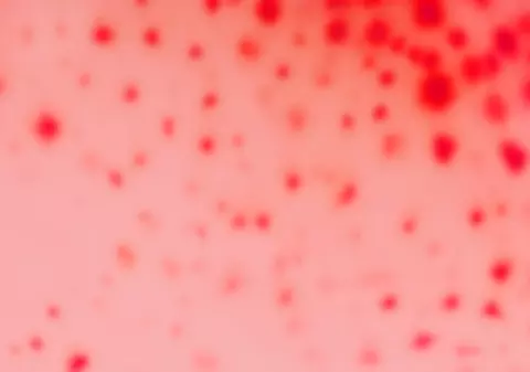 La nivel naţional, numărul cazurilor de îmbolnăvire cu rujeolă şi rubeolă a crescut