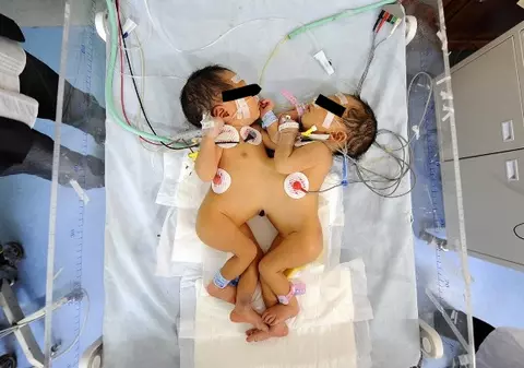 Două fetițe siameze s-au născut la Pitești