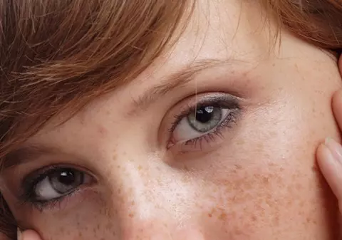 Află cum poţi scăpa de petele şi pistruii de pe faţă 