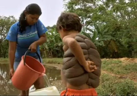 Drama copilului care a impresionat planeta a luat sfârşit! Cum arată "băiatul-ţestoasă" fără carapace! FOTO