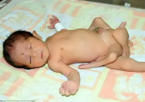 ŞOCANT! Un copil s-a născut cu ŞASE PICIOARE! | VIDEO