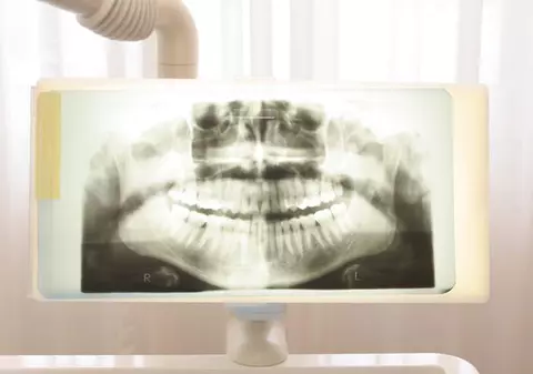 Radiografiile dentare pot provoca apariţia unor tumori pe creier