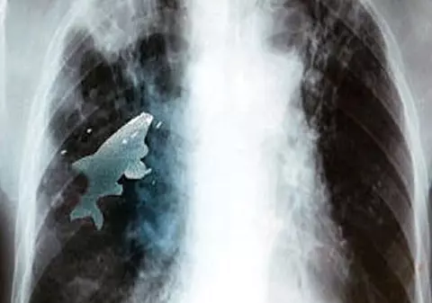 NU E O GLUMĂ! Medicii i-au scos un peşte de 9 centimetri din plămâni!