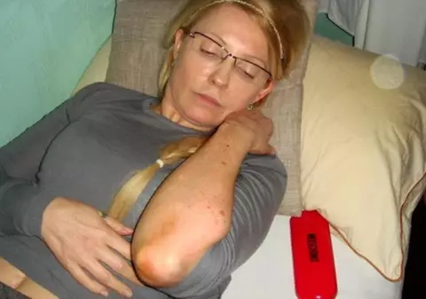 Iulia Timoşenko a contactat în închisoare o boală de piele necunoscută 