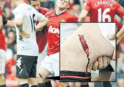 Wayne Rooney, atacantul lui Manchester United, a suferit o accidentare oribilă şi va lipsi o lună