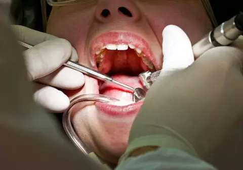 Oamenii merg la dentist de 6.500 de ani! S-a descoperit DOVADA CLARĂ