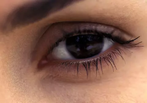 Persoanele cu ochi căprui riscă mai mult să se îmbolnăvească de vitiligo