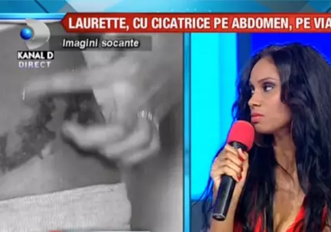 Laurette, traumatizată la un an după ce a fost arsă pe abdomen: «Nu o să mai fac în viața mea o intervenție cu laser»