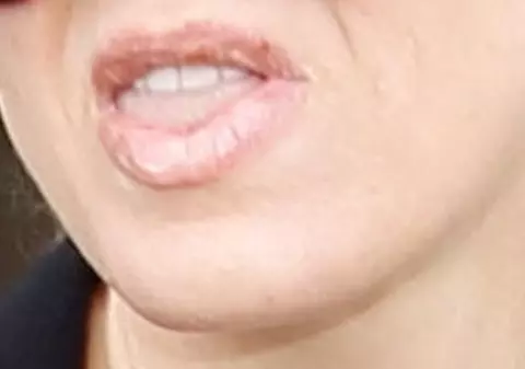 DESFIGURATĂ de OPERAȚIILE ESTETICE! Vedeta căreia i se descompun buzele | FOTO
