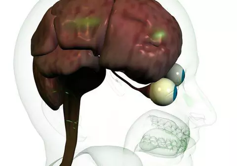 UN IMPLANT PE CREIER te-ar putea ajuta SĂ SLĂBEŞTI!