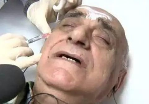 Am trăit s-o vedem și p-asta! Viorel Lis, injectat cu acid hialuronic