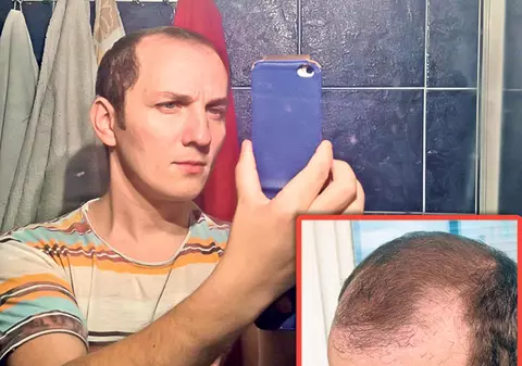 Trăistariu îşi măsoară zilnic părul! Cel mai lung fir măsoară deja o jumătate de centimetru