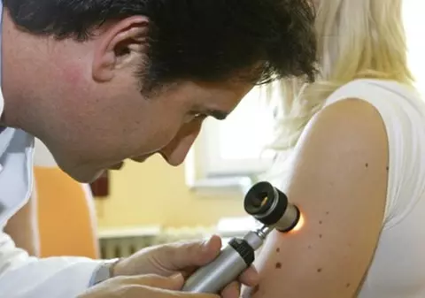 Atenţie la aluniţe: Melanomul, cea mai violentă formă de cancer!