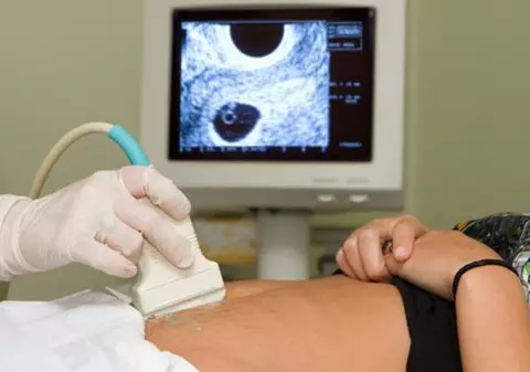 Durerea de ovare - ce înseamnă şi care sunt cauzele