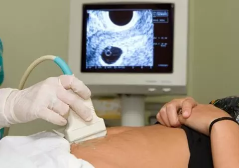 Durerea de ovare - ce înseamnă şi care sunt cauzele