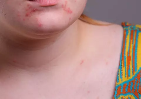Cum să ascunzi rapid coşurile de pe faţă