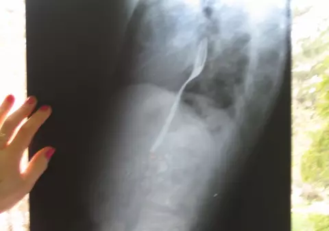Un tânăr din Bacău a înghiţit o furculiţă şi...A CÂŞTIGAT PARIUL!