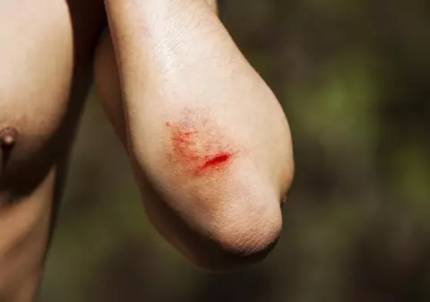 Cum faci ca rana să se vindece mai repede şi fără cicatrice